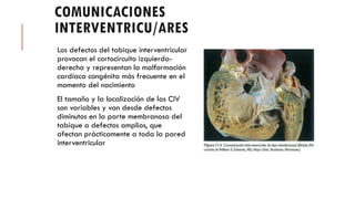 COMUNICACIONES
INTERVENTRICU/ARES
Los defectos del tabique interventricular
provocan el cortocircuito izquierda-
derecha y representan la malformación
cardíaca congénita más frecuente en el
momento del nacimiento
El tamaño y la localización de las CIV
son variables y van desde defectos
diminutos en la parte membranosa del
tabique a defectos amplios, que
afectan prácticamente a toda la pared
interventricular
 
