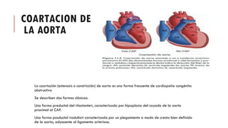 COARTACION DE
LA AORTA
La coartación (estenosis o constricción) de aorta es una forma frecuente de cardiopatía congénita
obstructiva
Se describen dos formas clásicas:
Una forma preductal del «lactante», caracterizada por hipoplasia del cayado de la aorta
proximal al CAP.
Una forma posductal «adulta» caracterizada por un plegamiento a modo de cresta bien definido
de la aorta, adyacente al ligamento arterioso.
 