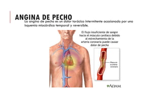 ANGINA DE PECHO
La angina de pecho es un dolor torácico intermitente ocasionado por una
isquemia miocárdica temporal y reversible.
 