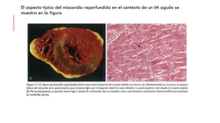El aspecto típico del miocardio reperfundido en el contexto de un IM agudo se
muestra en la figura
 