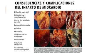 CONSECUENCIAS Y COMPLICACIONES
DEL INFARTO DE MIOCARDIO
Disfunción contráctil
Disfunción del
músculo papilar
Infarto del ventrículo
derecho
Rotura del miocardio
Arritmias
Pericarditis
Dilatación de las
cavidades
Trombo mural
Aneurisma
ventricular
Insuficiencia
cardiaca congestiva
 