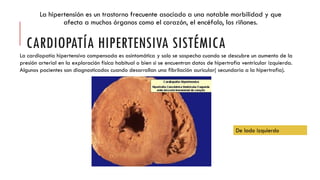 La hipertensión es un trastorno frecuente asociado a una notable morbilidad y que
afecta a muchos órganos como el corazón, el encéfalo, los riñones.
CARDIOPATÍA HIPERTENSIVA SISTÉMICA
La cardiopatía hipertensiva compensada es asintomática y solo se sospecha cuando se descubre un aumento de la
presión arterial en la exploración física habitual o bien si se encuentran datos de hipertrofia ventricular izquierda.
Algunos pacientes son diagnosticados cuando desarrollan una fibrilación auricular( secundaria a la hipertrofia).
De lado izquierdo
 