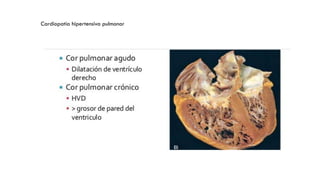 Cardiopatía hipertensiva pulmonar
 