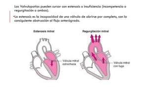 Las Valvulopatias pueden cursar con estenosis o insuficiencia (incompetencia o
regurgitación o ambas).
•La estenosis es la incapacidad de una válvula de abrirse por completo, con la
consiguiente obstrucción al flujo anterógrado.
 