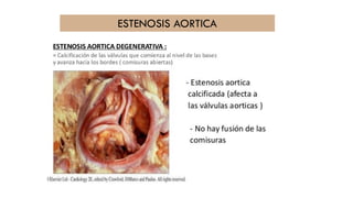 ESTENOSIS AORTICA
 