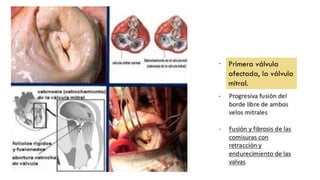 Primera válvula
afectada, la válvula
mitral.
 