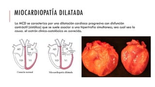 MIOCARDIOPATÍA DILATADA
La MCD se caracteriza por una dilatación cardiaca progresiva con disfunción
contráctil (sistólica) que se suele asociar a una hipertrofia simultanea; sea cual sea la
causa, el patrón clínico-patológico es parecido.
 