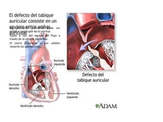Comunicación
interauricular (CIA)
La circulación pulmonar pude ser
doble o cuádruple de lo normal.
Soplo a raíz del exceso del flujo a
través de la válvula pulmonar.
El cierre quirúrgico o por catéter
revierte las alteraciones.
 