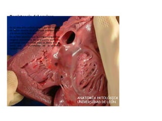 Persistencia del agujero
oval
Es un pequeño orificio creado por un colgajo
de tejido abierto en el tabique interauricular
a la altura de la fosa oval.
En el feto permite que la sangre cargada de
oxigeno procedente de la placenta evite los
pulmones aún sin inflar, esta se cierra tras el
parto por el incremento de la presión
sanguínea.
 
