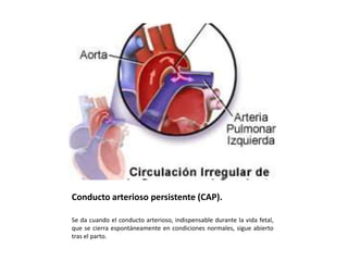 Conducto arterioso persistente (CAP).

Se da cuando el conducto arterioso, indispensable durante la vida fetal,
que se cierra espontáneamente en condiciones normales, sigue abierto
tras el parto.
 