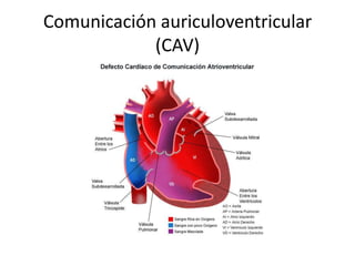 Comunicación auriculoventricular
            (CAV)
 