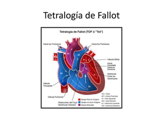 Tetralogía de Fallot
 