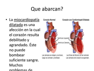 Que abarcan?
• La miocardiopatía
  dilatada es una
  afección en la cual
  el corazón resulta
  debilitado y
  agrandado. Éste
  no puede
  bombear
  suficiente sangre.
  Muchos
 