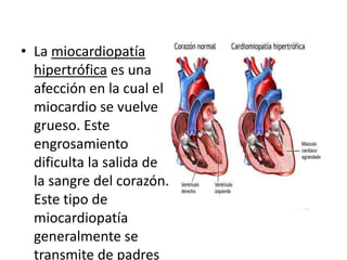 • La miocardiopatía
  hipertrófica es una
  afección en la cual el
  miocardio se vuelve
  grueso. Este
  engrosamiento
  dificulta la salida de
  la sangre del corazón.
  Este tipo de
  miocardiopatía
  generalmente se
  transmite de padres
 