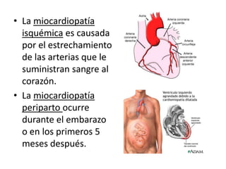 • La miocardiopatía
  isquémica es causada
  por el estrechamiento
  de las arterias que le
  suministran sangre al
  corazón.
• La miocardiopatía
  periparto ocurre
  durante el embarazo
  o en los primeros 5
  meses después.
 