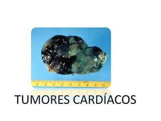 TUMORES CARDÍACOS
 