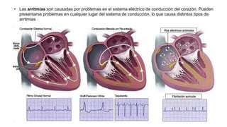 • Las arritmias son causadas por problemas en el sistema eléctrico de conducción del corazón. Pueden
presentarse problemas en cualquier lugar del sistema de conducción, lo que causa distintos tipos de
arritmias
 