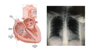 Corazón Sistema Cardionector
