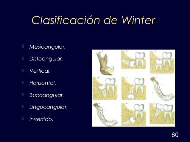 cirugia del cordal retenido