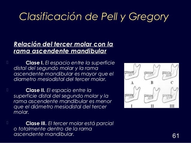 cirugia del cordal retenido