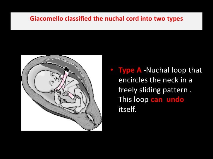 Cord around the_neck.