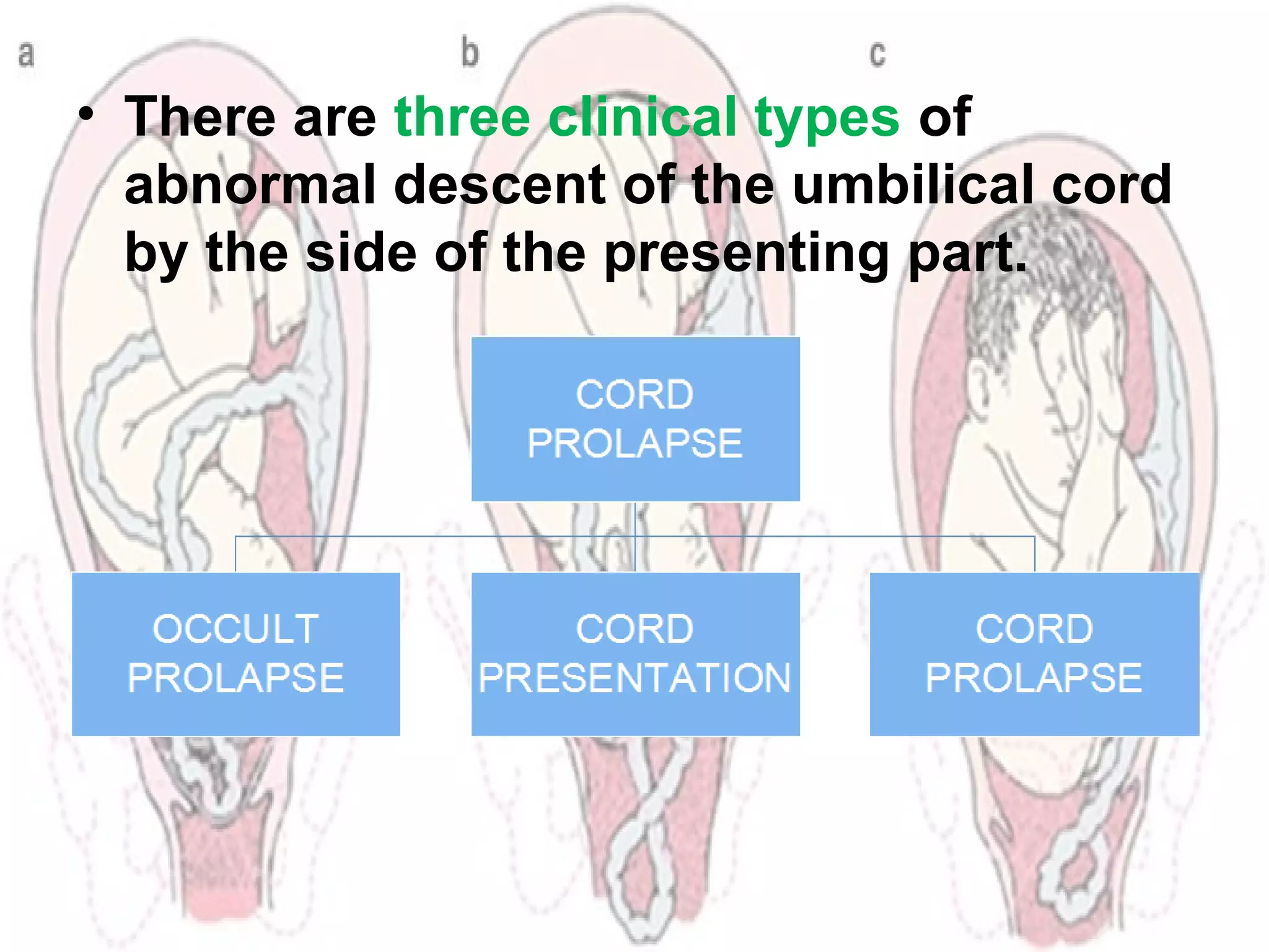 Cord prolapse PPT