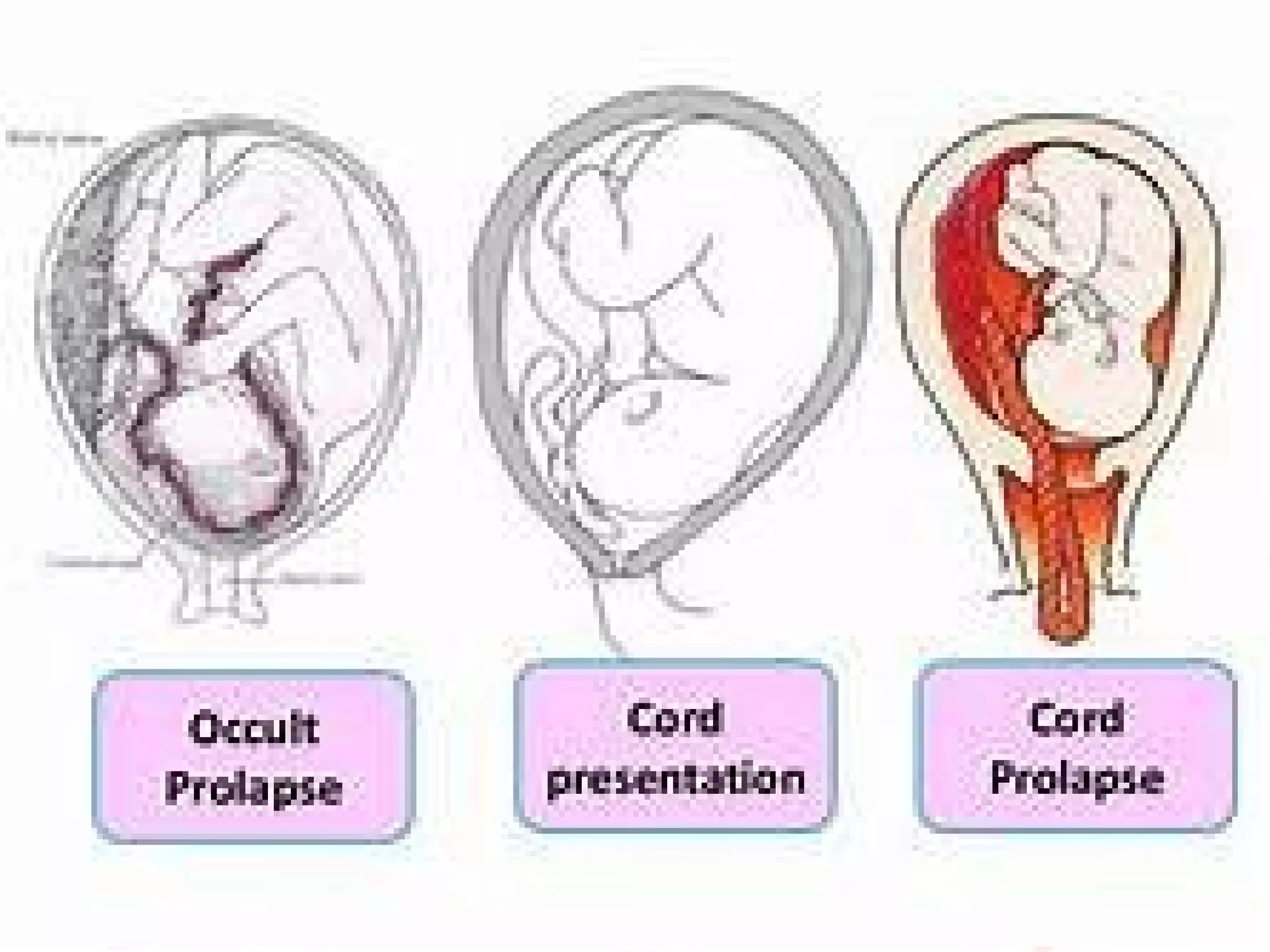 Cord prolapse PPT
