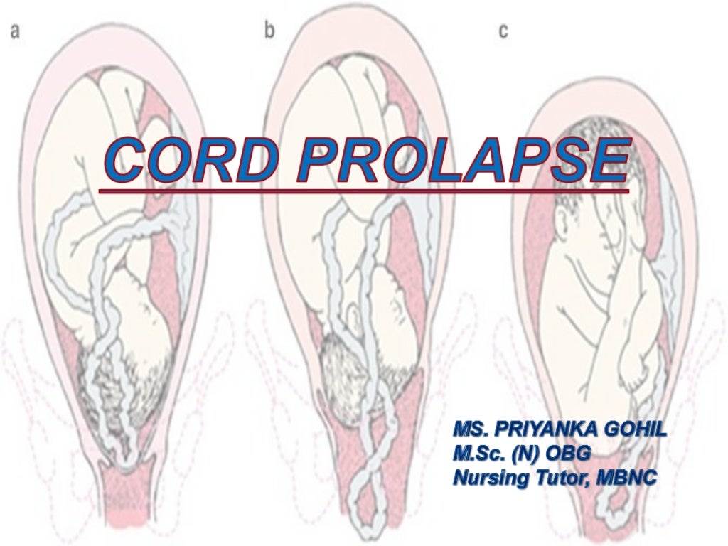 Cord prolapse
