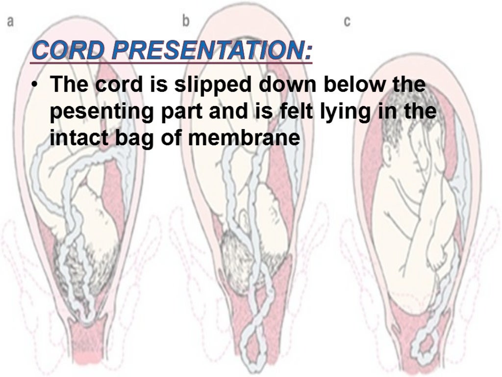 Cord prolapse