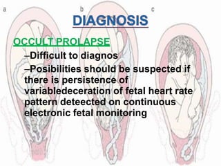 OCCULT PROLAPSE
–Difficult to diagnos
–Posibilities should be suspected if
there is persistence of
variabledeceration of fetal heart rate
pattern deteected on continuous
electronic fetal monitoring
 