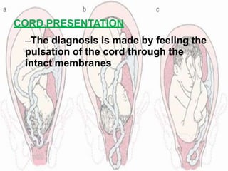 CORD PRESENTATION
–The diagnosis is made by feeling the
pulsation of the cord through the
intact membranes
 