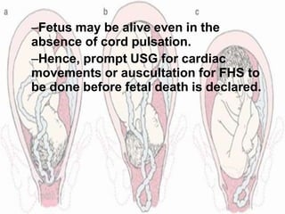 –Fetus may be alive even in the
absence of cord pulsation.
–Hence, prompt USG for cardiac
movements or auscultation for FHS to
be done before fetal death is declared.
 