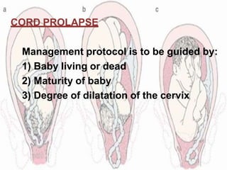 CORD PROLAPSE
Management protocol is to be guided by:
1) Baby living or dead
2) Maturity of baby
3) Degree of dilatation of the cervix
 