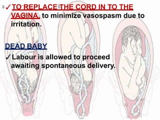 ✓TO REPLACE THE CORD IN TO THE
VAGINA, to minimize vasospasm due to
irritation.
DEAD BABY
✓Labour is allowed to proceed
awaiting spontaneous delivery.
 