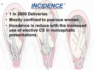 • 1 in 3000 Deliveries
• Mostly confined to paarous women
• Incedence is reduce with the increased
use of elective CS in noncephalic
presentations.
 