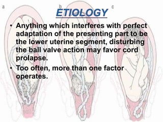 • Anything which interferes with perfect
adaptation of the presenting part to be
the lower uterine segment, disturbing
the ball valve action may favor cord
prolapse.
• Too often, more than one factor
operates.
 