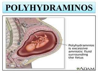 POLYHYDRAMINOS
 