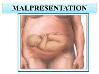 MALPRESENTATION
 