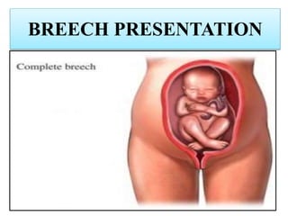 BREECH PRESENTATION
 