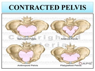 CONTRACTED PELVIS
 