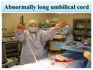 Abnormally long umbilical cord
 