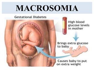 MACROSOMIA
 