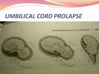 UMBILICAL CORD PROLAPSE
 