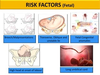 Breech/Malpresentations Transverse, Oblique and
unstable lie
High head at onset of labour
Fetal Congenital
anomalies
Long umbilical cord
RISK FACTORS (Fetal)
 