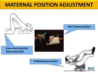 Sim’s lateral position
Knee-chest position
(Genu-pectoral)
• Tredelenburg position
MATERNAL POSITION ADJUSTMENT
 