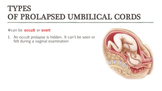 TYPES
OF PROLAPSED UMBILICAL CORDS
❖can be occult or overt
1. An occult prolapse is hidden. It can't be seen or
felt during a vaginal examination
 