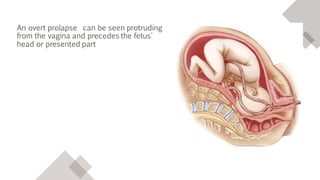 An overt prolapse can be seen protruding
from the vagina and precedes the fetus'
head or presented part
 