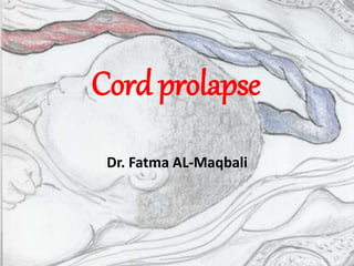 Cord prolapse
Dr. Fatma AL-Maqbali
 