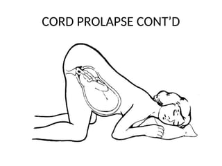 CORD PROLAPSE CONT’D
 