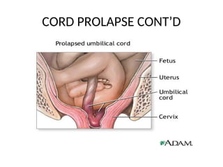 CORD PROLAPSE CONT’D
 